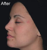Acne laser treatment after