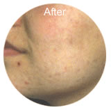 Acne laser treatment after