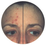 Acne laser treatment 