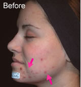 Acne laser treatment before