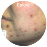 Acne laser treatment before