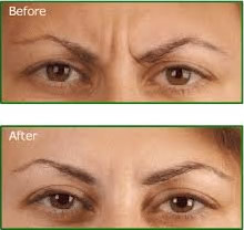 botox