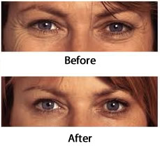 botox