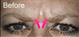 Botox before photo number elevens