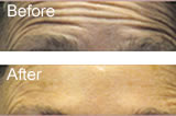 Botox before and after forehead lines