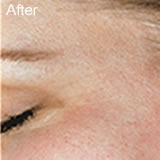 Microdermabrasion fine lines treatment after photo