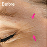 Microdermabrasion fine lines treatment before photo