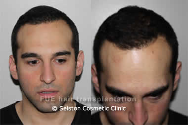 Hair transplant