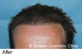 hair restoration before and after