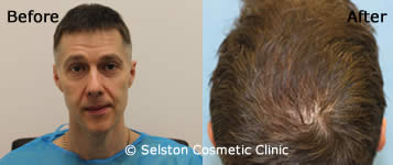 hair restore