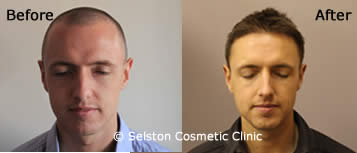hair restoration