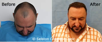 hair restoration