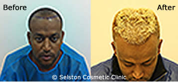 hair regrowth