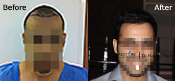hair regrowth