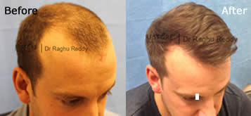 hair regrowth