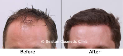 hair transplant
