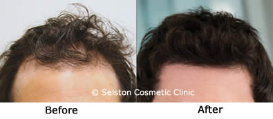 hair regrowth