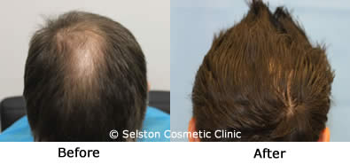 hair renewal