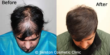 hair restoration