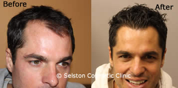 hair restore