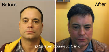 hair regrowth