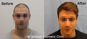 hair restoration
