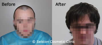 hair regain