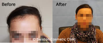 hair restore