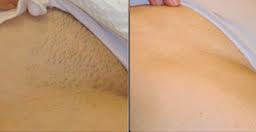 Hair removal