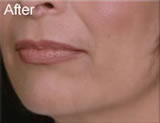 Jowls correction after photo