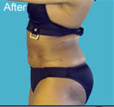 Abdomen and flanks liposuction after photo
