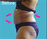 Abdomen and flanks liposuction before photo