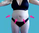 Stomach and love handles liposuction before photo