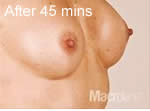 Macrolane breast enhancement after photo