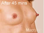 Macrolane breast enhancement after photo