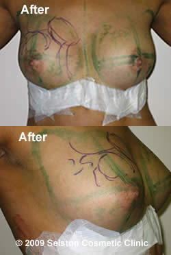 After Macrolane client 1