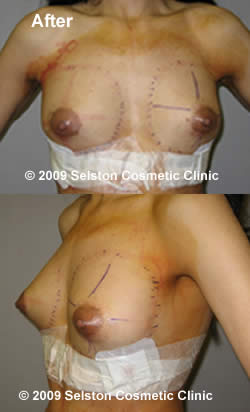 After Macrolane client 2