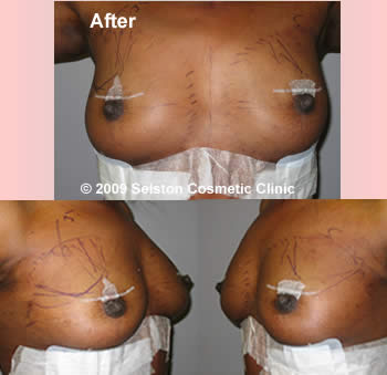 After Macrolane client 3
