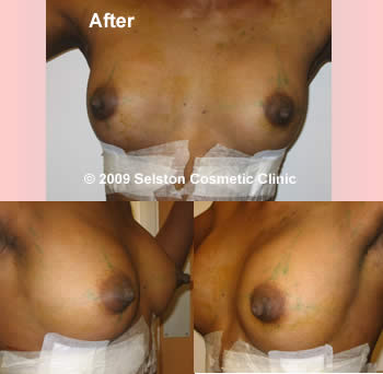 After Macrolane client 4
