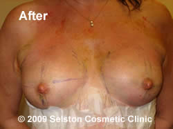 After Macrolane client5