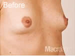 Macrolane breast enhancement before photo
