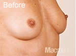 Macrolane breast enhancement before photo