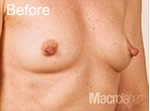 Macrolane breast enhancement before photo