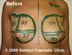 Before Macrolane client 1