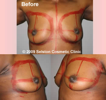 Before Macrolane client 3