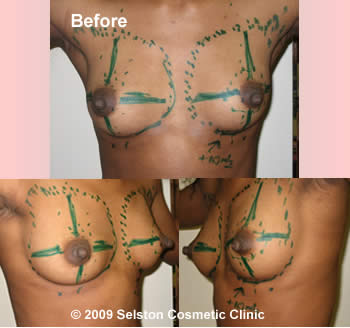Before Macrolane client 4