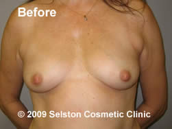 Before Macrolane client 5