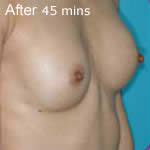 Macrolane breast enhancement after photo