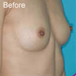 Macrolane breast enhancement before photo