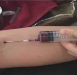 prp injection